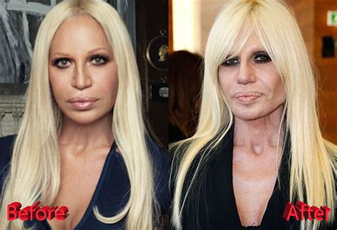 donatella versace før og efter|Donatella Versace brand.